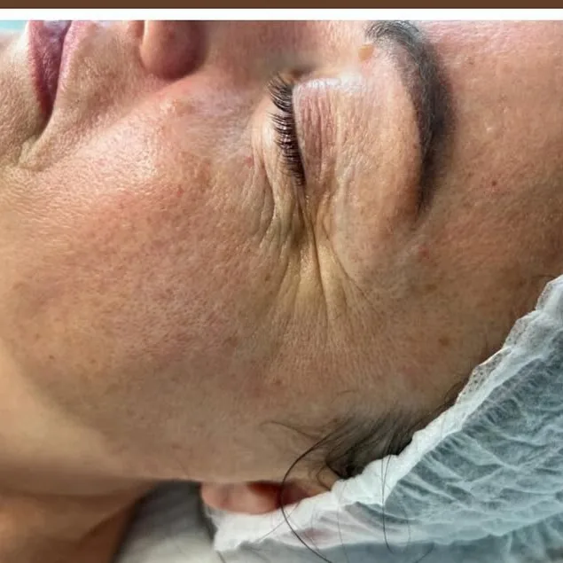 Anti-aging programa prieš - veido procedūra Palangoje